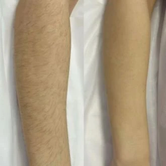 IPL System 2